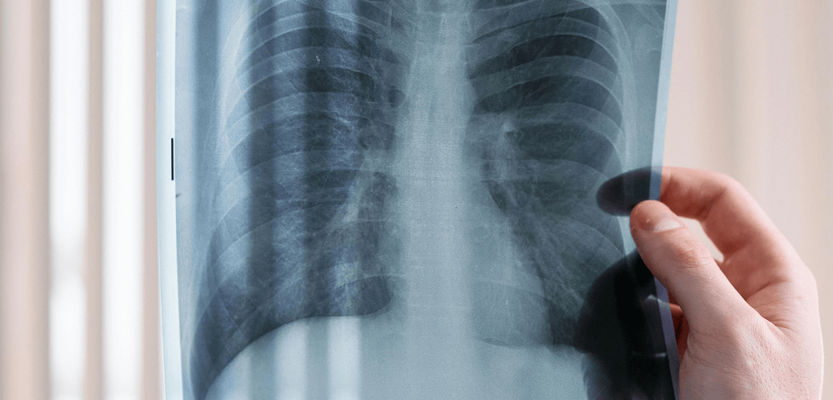 IPO do Porto é premiado pela sua visão inovadora no tratamento do cancro do pulmão